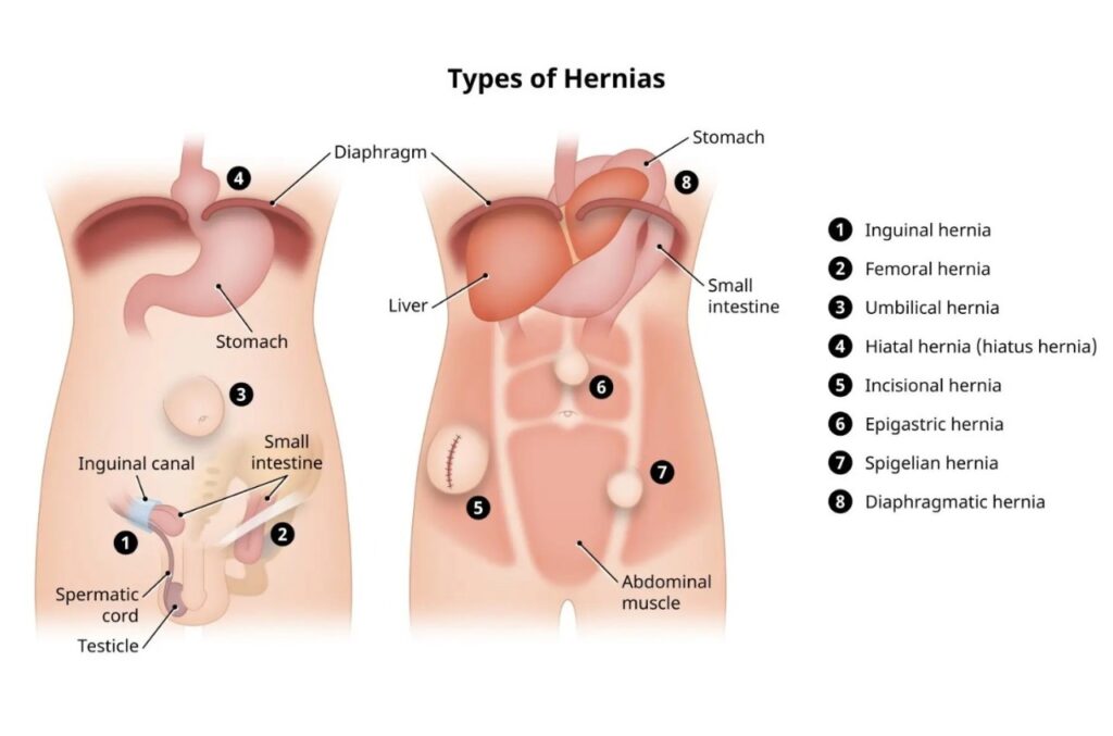 when to see a doctor for hernia
