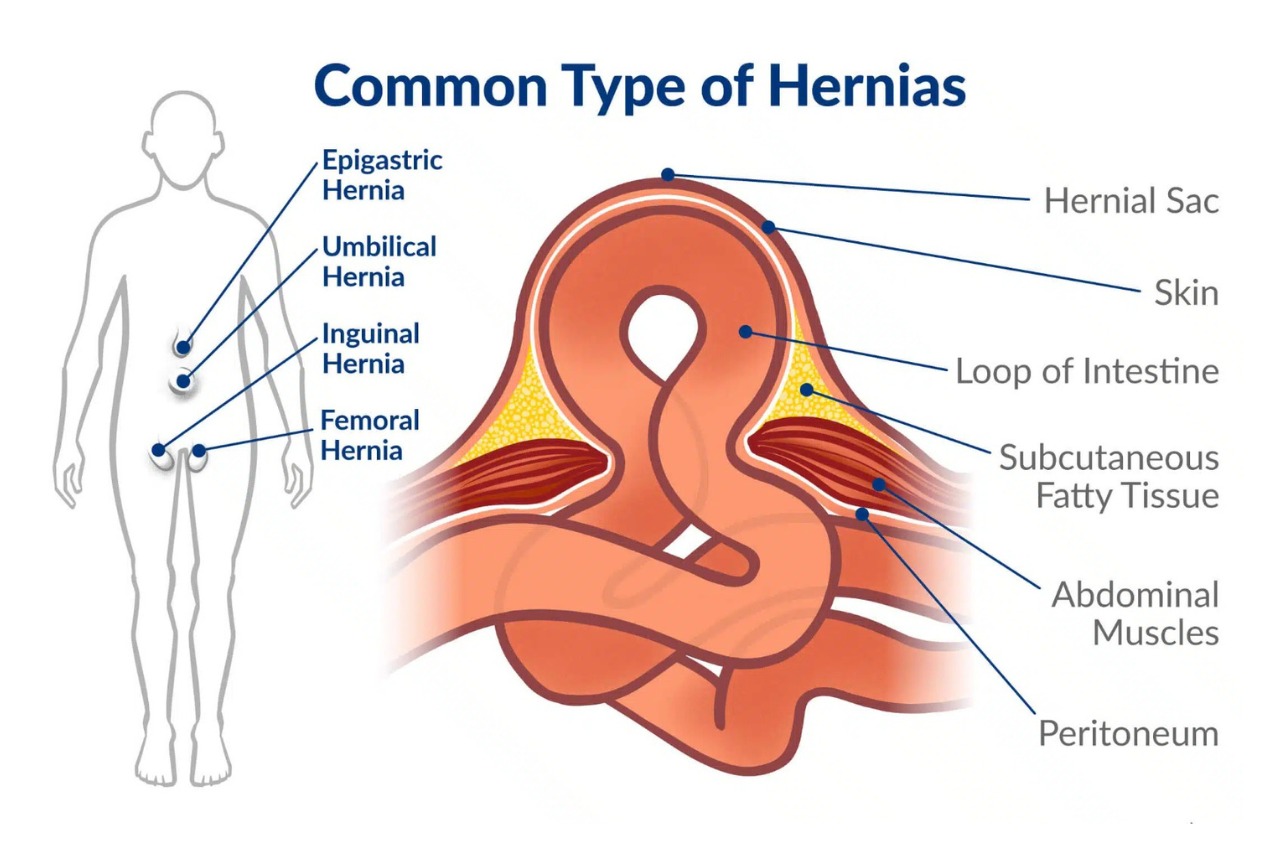 When to see a foctor for hernia