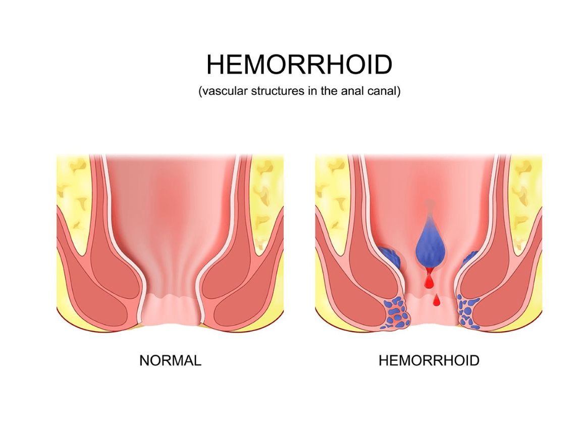 Best Piles Surgeon in Kolkata