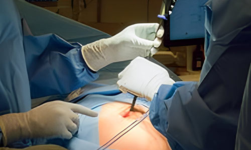 Open Appendectomy (Traditional Approach) | Dr. Ashutosh Nayak