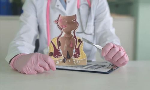 Transsphincteric Fistula