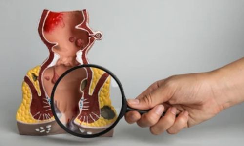 Extrasphincteric Fistula