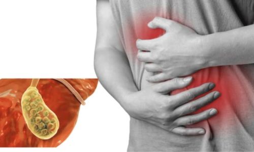 Cholecystitis (Gallbladder Inflammation)