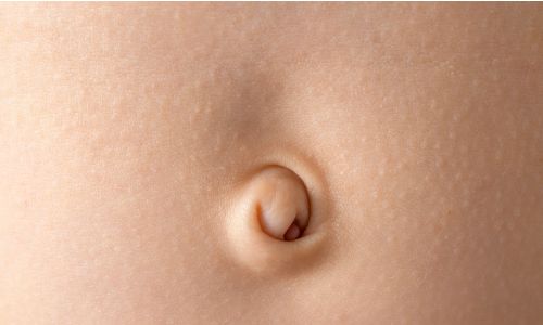 Umbilical Hernia