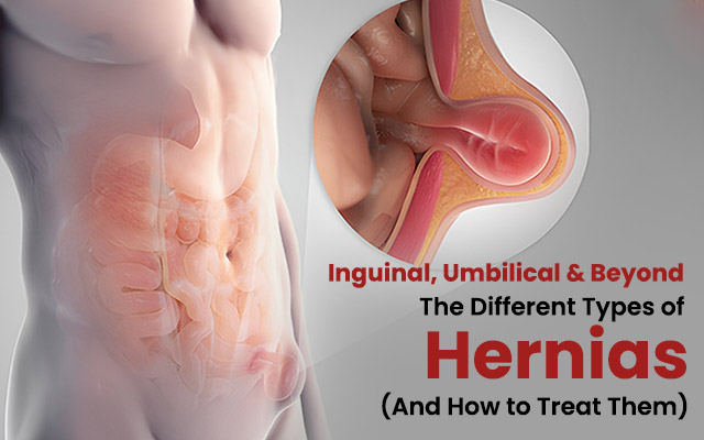 Types of Hernias