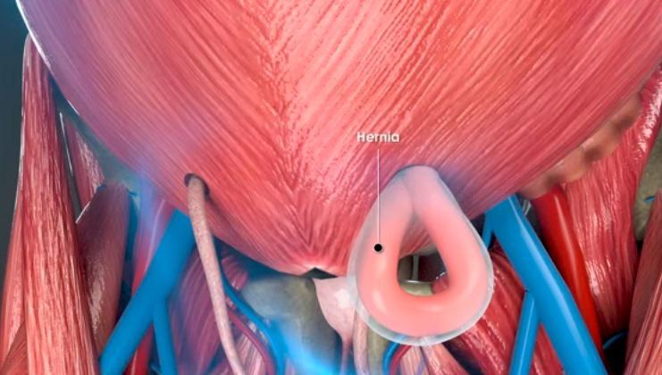 Illustration showing an abdominal hernia caused by strain from lifting heavy objects like bags or water cans