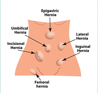 Diagram showing different types of hernias, including epigastric, umbilical, inguinal, femoral, lateral, and incisional hernias.