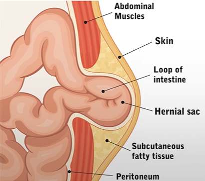 Anatomical diagram showing the layers involved in a hernia, including abdominal muscles, skin, intestine, and peritoneum.