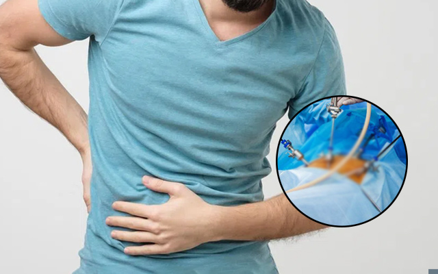 Image of a person with a hand on their stomach, showing signs of pain or discomfort, with a close-up inset of laparoscopic surgical tools used in hernia repair.